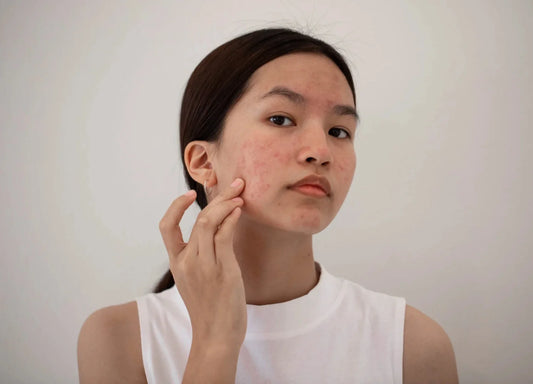 Face mapping : comprendre la cause de ses boutons en fonction de leur zone